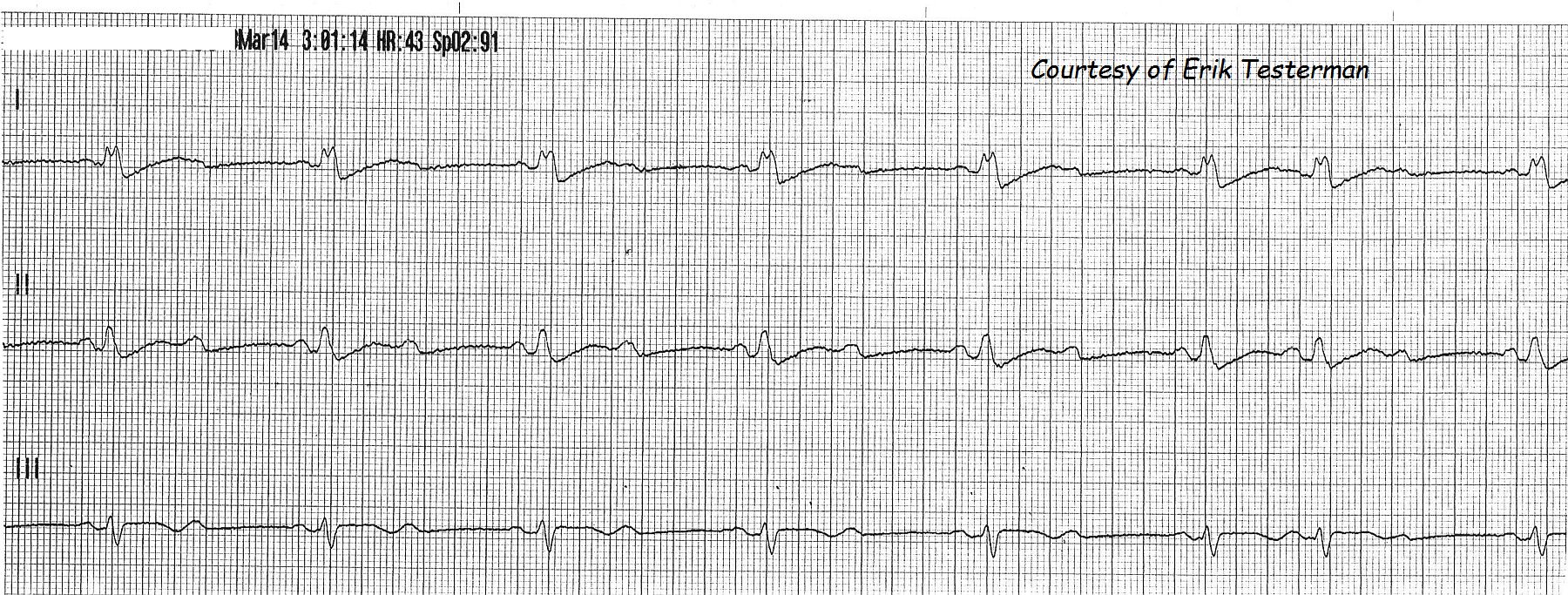 second-degree-a-v-block-ecg-guru-instructor-resources